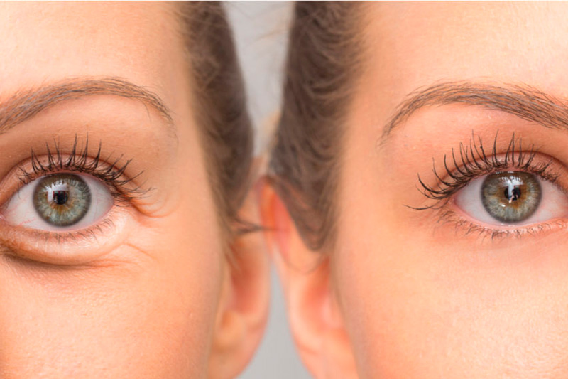 before and after of under eye bag treatment