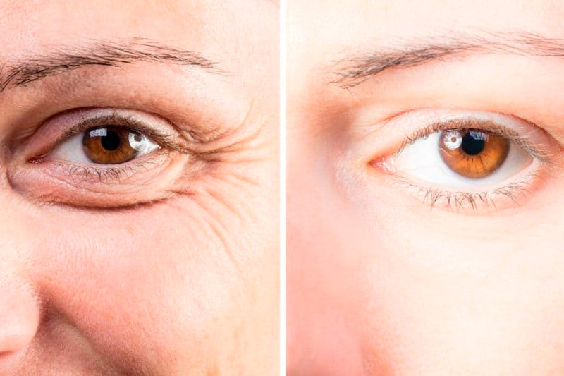 before and after results of Softening of Deeper Wrinkles