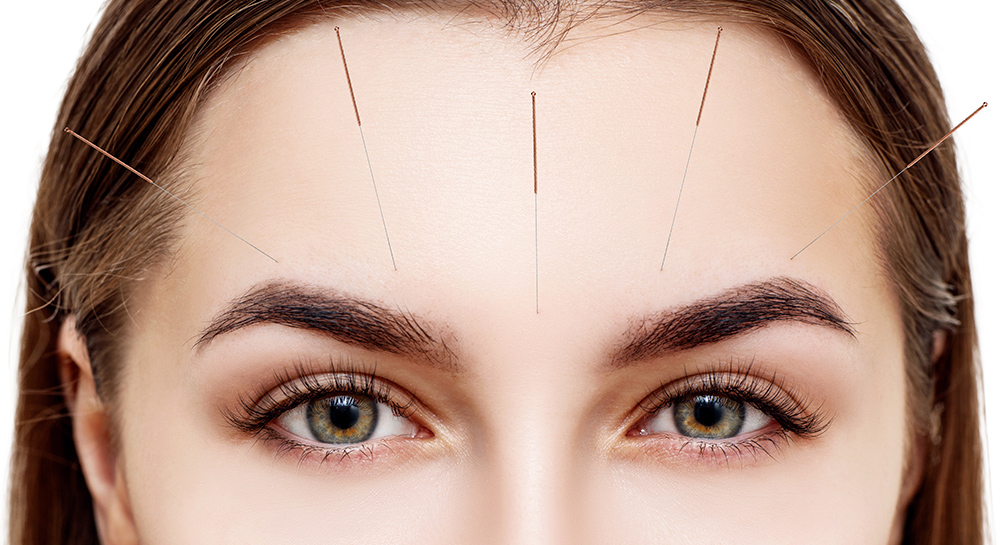woman receiving Cosmetic Acupuncture treatment