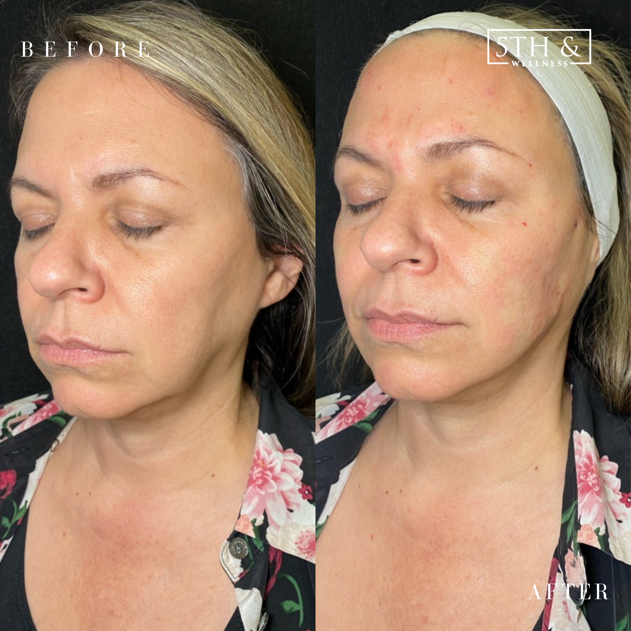 before and after results from 5th and Wellness treatment