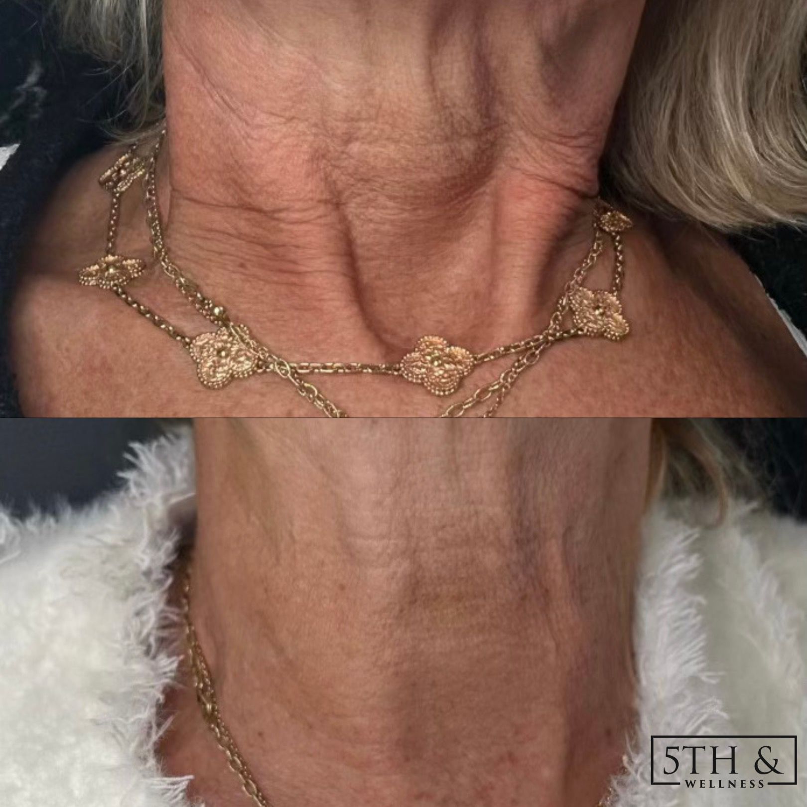 before and after results from Hyperdilute Radiesse treatment