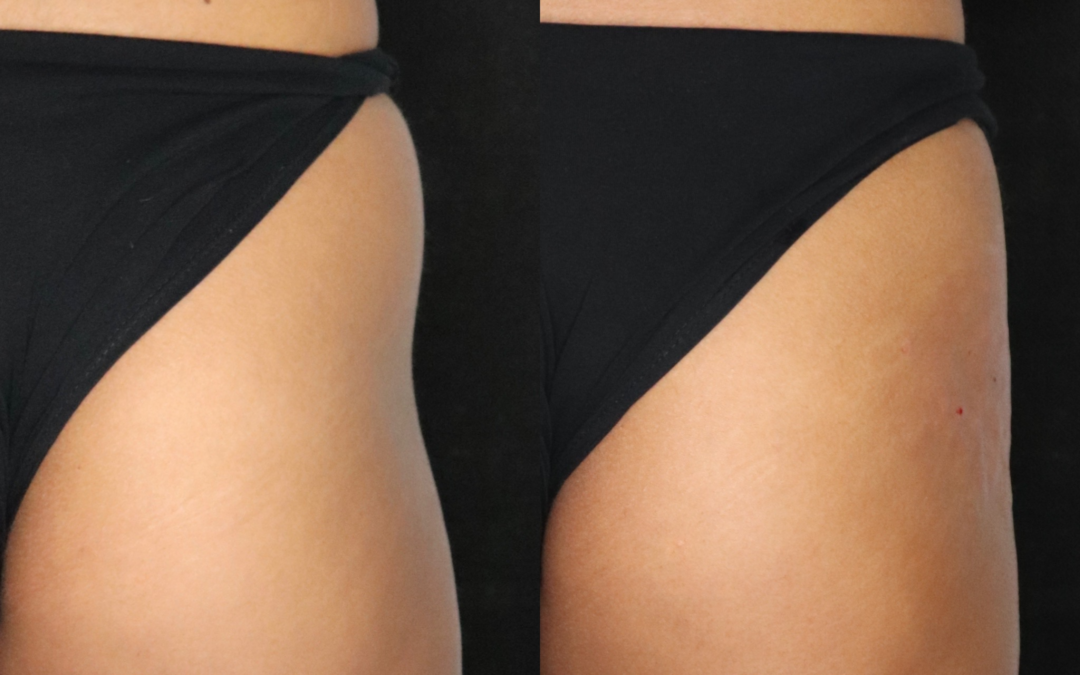 before and after results from 5th and Wellness treatment