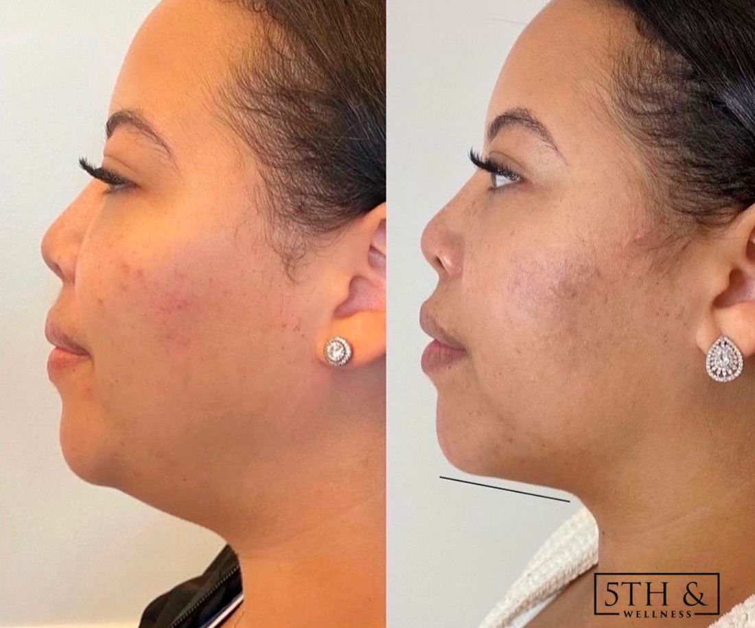 before and after results from Kybella treatment