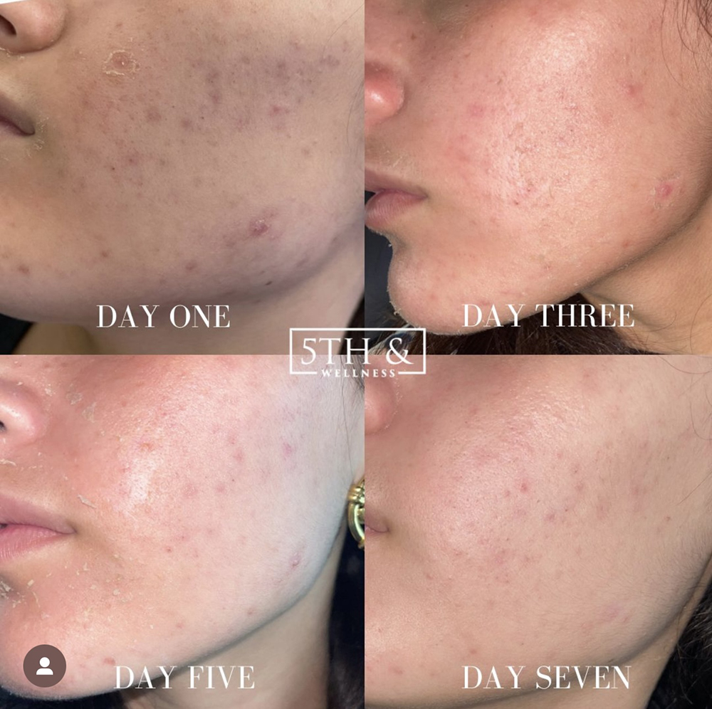 Chemical Peel Before & After Gallery Boca Raton 5th & Wellness