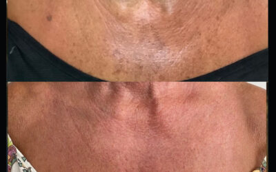 before and after results from Chemical Peel treatment at 5th and Wellness in Boca Raton, FL