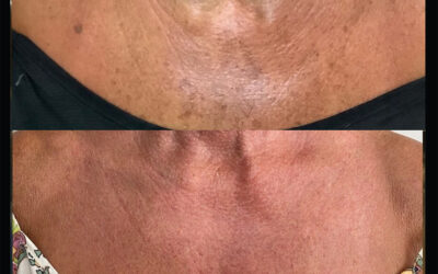 before and after results from Clear + Brilliant treatment at 5th and Wellness in Boca Raton, FL