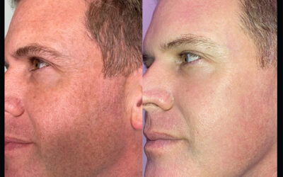 before and after results from Clear + Brilliant treatment at 5th and Wellness in Boca Raton, FL