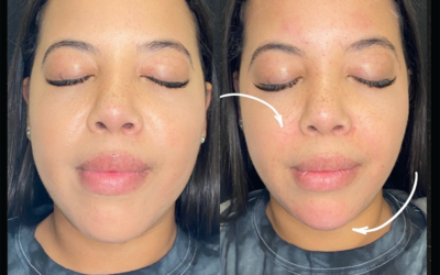 before and after results from filler treatment at 5th and Wellness in Boca Raton, FL