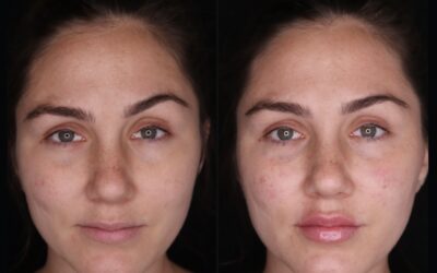 before and after results from filler treatment at 5th and Wellness in Boca Raton, FL