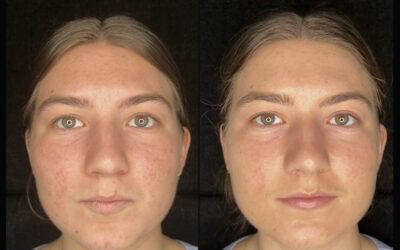 before and after results from Hydrafacial treatment at 5th and Wellness in Boca Raton, FL