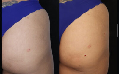 before and after results from Hyperdilute Radiesse treatment at 5th and Wellness in Boca Raton, FL