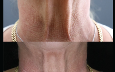 before and after results from Hyperdilute Radiesse treatment at 5th and Wellness in Boca Raton, FL
