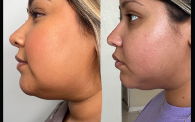 before and after results from Kybella treatment at 5th and Wellness in Boca Raton, FL