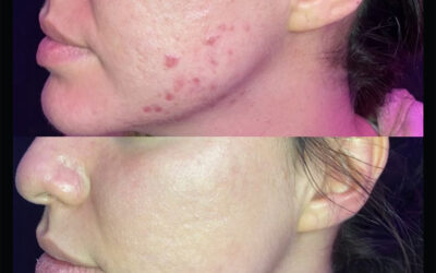before and after results from Morpheus8 treatment at 5th and Wellness in Boca Raton, FL