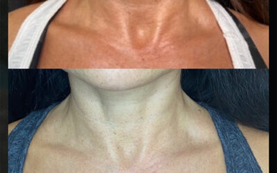 before and after results from Morpheus8 treatment at 5th and Wellness in Boca Raton, FL