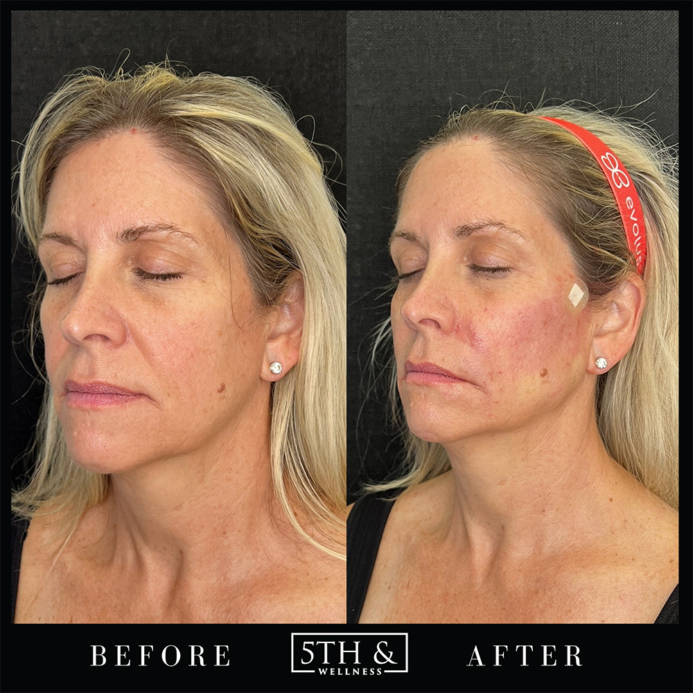PDO Threads Before & After Images Boca Raton 5th & Wellness