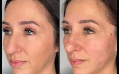 before and after results from PDO threads treatment at 5th and Wellness in Boca Raton, FL
