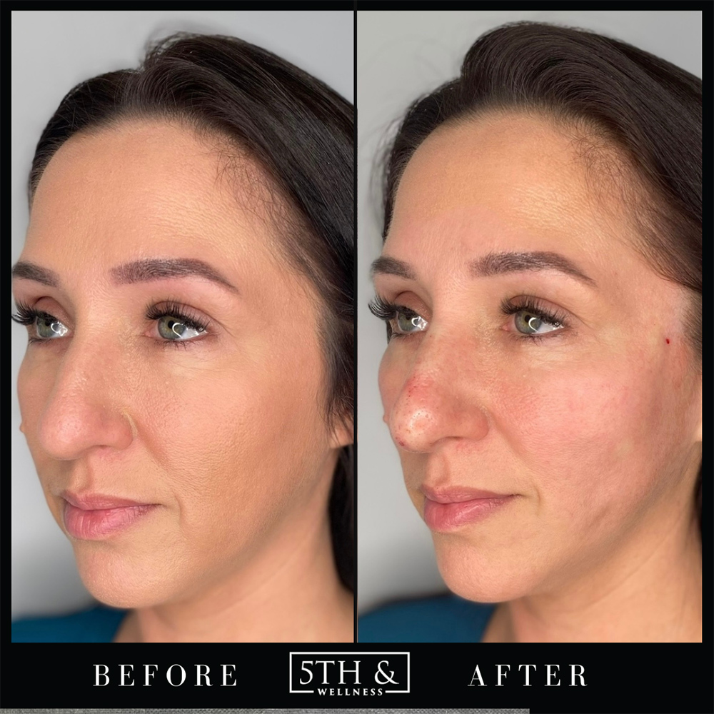 PDO Threads Before & After Images Boca Raton 5th & Wellness