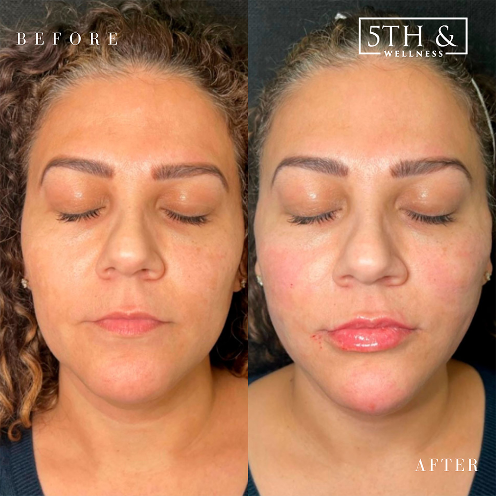 PDO Threads Before & After Images Boca Raton 5th & Wellness