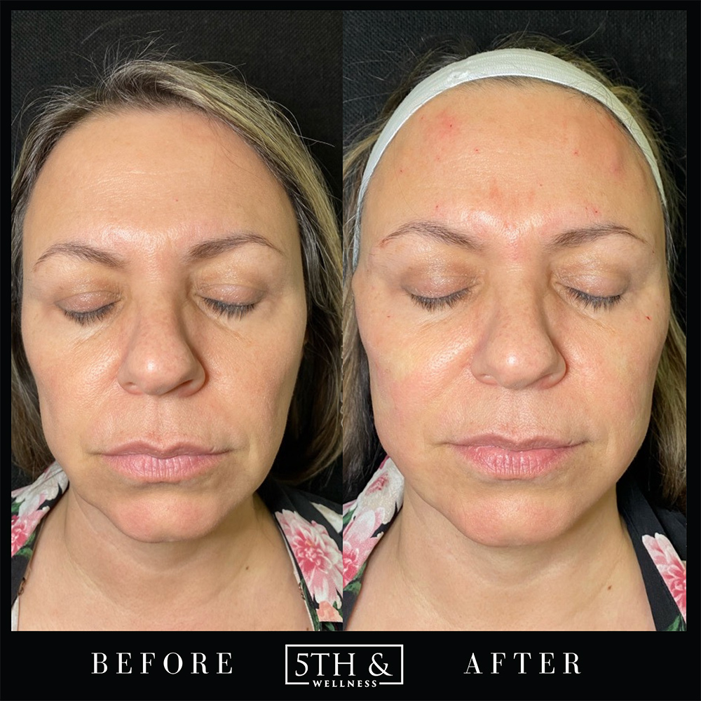 PDO Threads Before & After Images Boca Raton 5th & Wellness