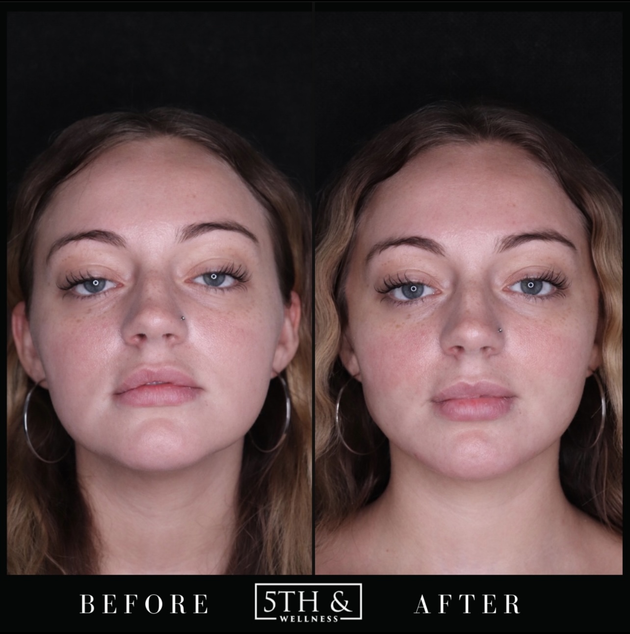 PDO Threads Before & After Images Boca Raton 5th & Wellness