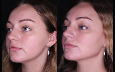 before and after results from PDO threads treatment at 5th and Wellness in Boca Raton, FL