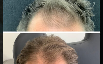 before and after results from PRP/PRF treatment at 5th and Wellness in Boca Raton, FL