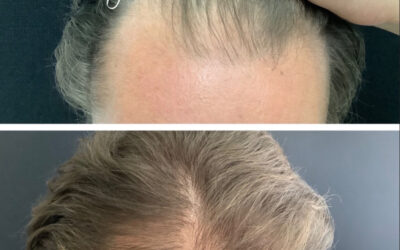 before and after results from PRP/PRF treatment at 5th and Wellness in Boca Raton, FL