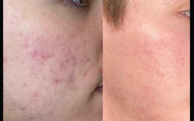 before and after results from skinpen microneedling treatment at 5th and Wellness in Boca Raton, FL
