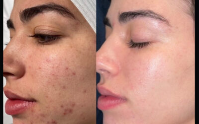 before and after results from skinpen microneedling treatment at 5th and Wellness in Boca Raton, FL