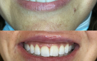 before and after results from tox treatment at 5th and Wellness in Boca Raton, FL