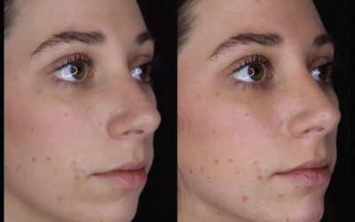 Filler Before and After Photo