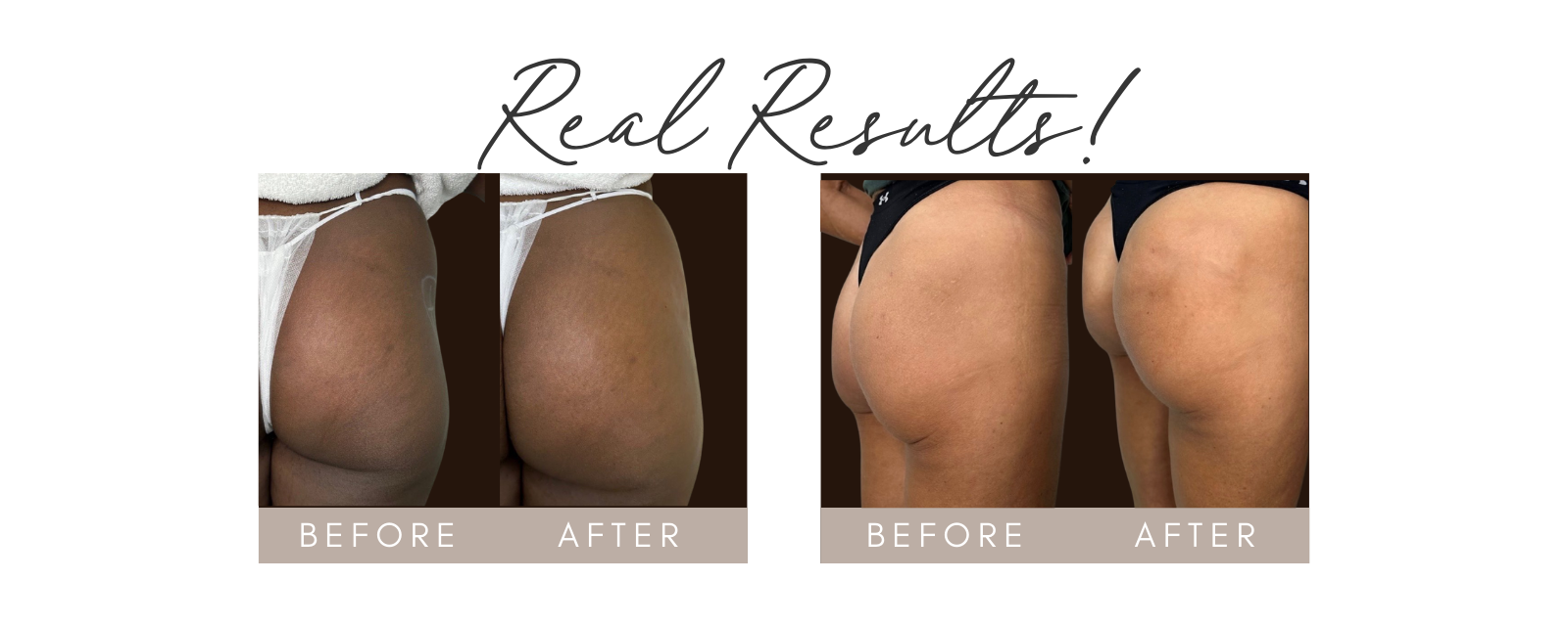 4 CoolPeel before and after photos